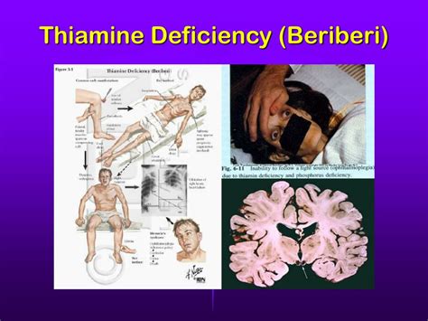 beriberi pictures|Beriberi (Thiamine Deficiency): Practice Essentials, .